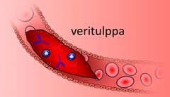 Kun suoneen syntyy veritulppa, verenkierto estyy. Jos kysymyksessä on valtimo, seuraa elinvaurio tai kuolio. Jos taas kysymyksessä on laskimo, veren paluu hapetettavaksi häiriintyy, jolloin syntyy paikallista turvotusta ja kudostuhoa. Kuva: Heikki Valkonen