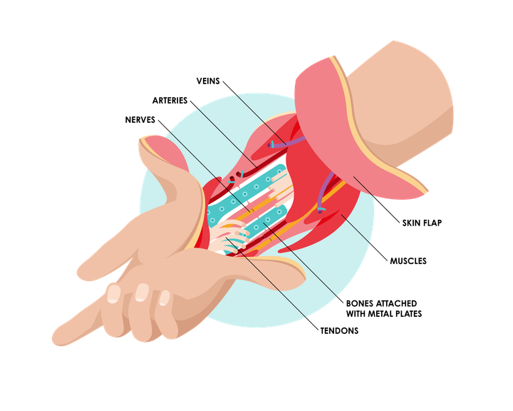 An anatomical drawing showing how a hand transplantation is performed. The drawing shows structures of the hand: a skin flap, bones attached with metal plates, arteries, veins, nerves, and tendons.