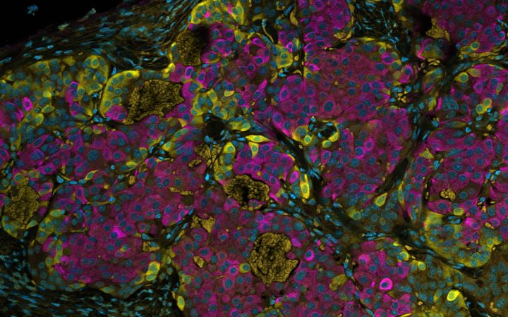 Ihmisen turvakäsiteltyjä kantasoluja, jotka on siirretty koe-eläimeen. Solut ovat erilaistuneet tuottamaan ihmisen haimasolujen proteiineja. Kuvassa insuliini näkyy vaaleanpunaisella, glukagoni keltaisella ja tuman DNA sinisellä.